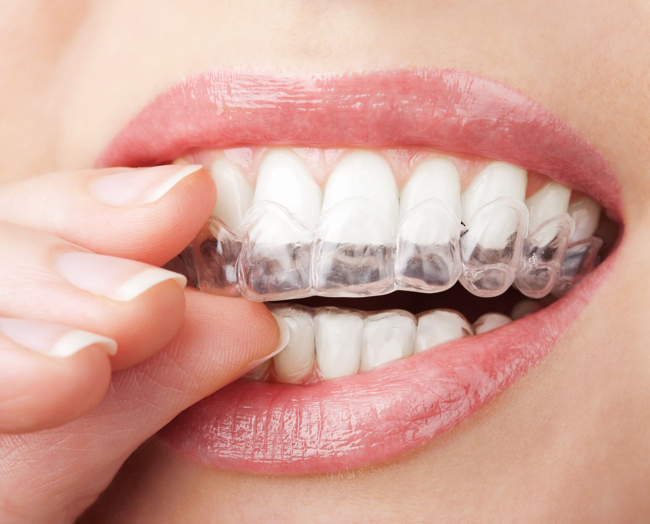 Benefits of Clear Braces in Long Beach, CA