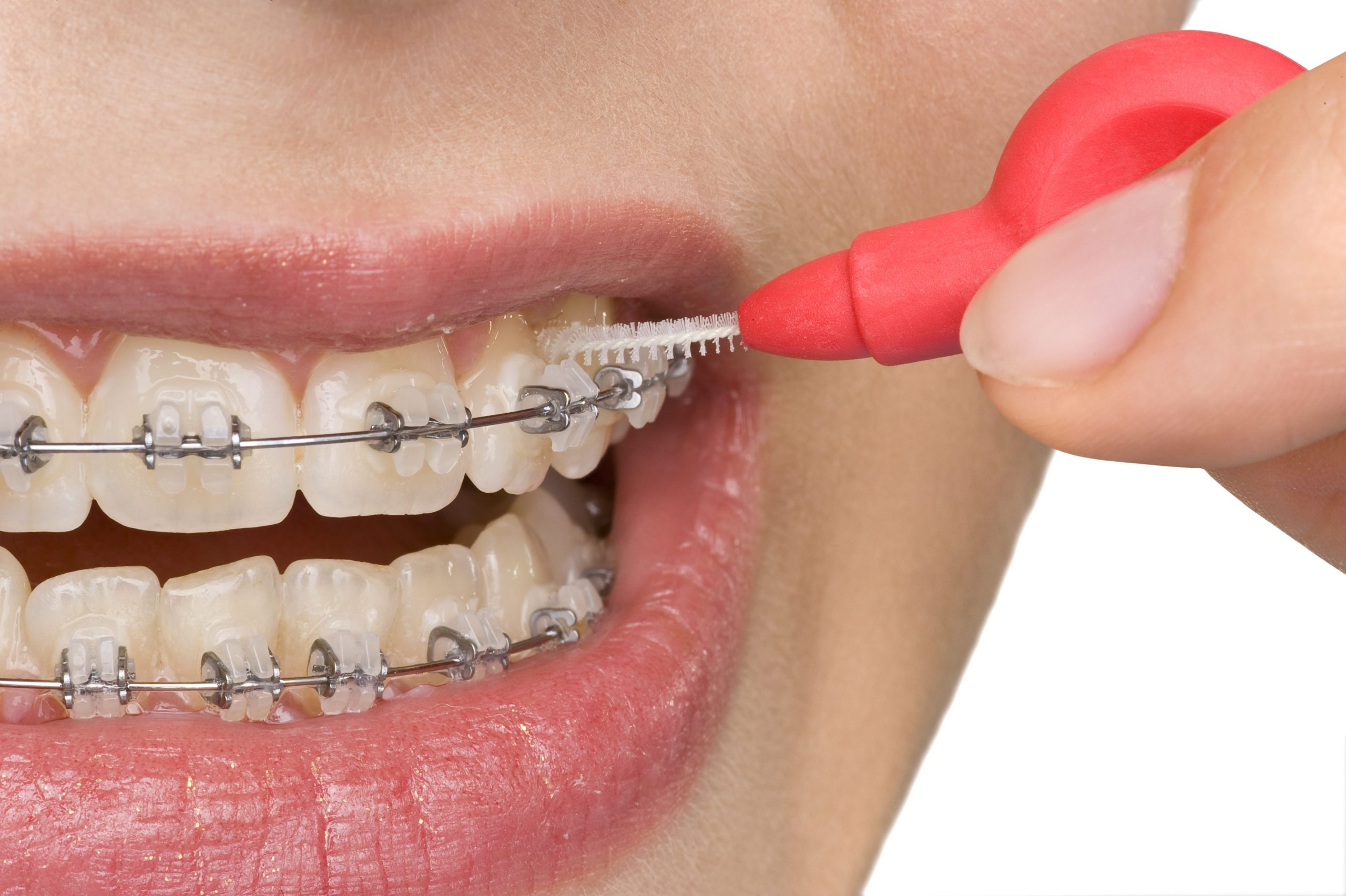 Enhance Your Smile with Dental Braces in Long Beach, CA