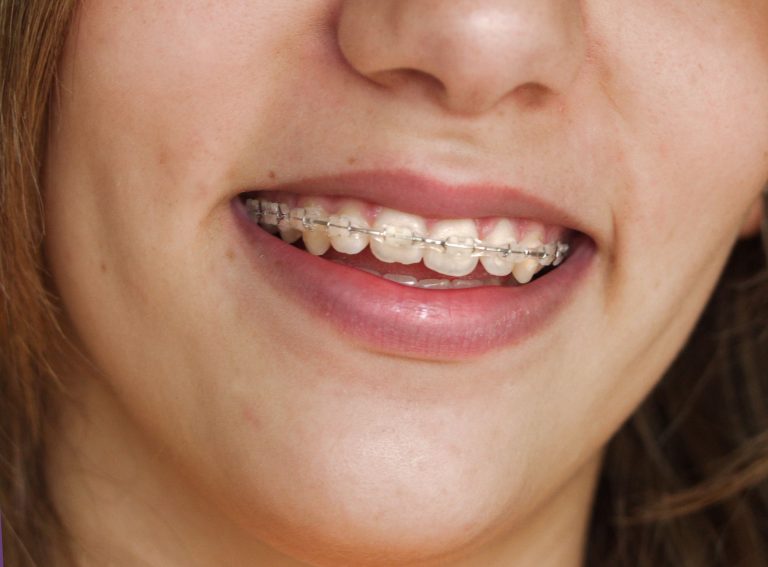 Why Select a Family Orthodontist in Medina, OH?